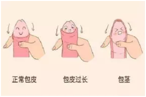 这个暑假，嘉辰特聘湘雅附三专家号称包皮王子万波教授助你家男孩“崭露头角”